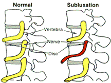 Subluxations are corrected at Colonia Chiropractic Center