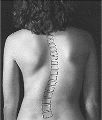 regular chiropractic checkups can prevent scoliosis